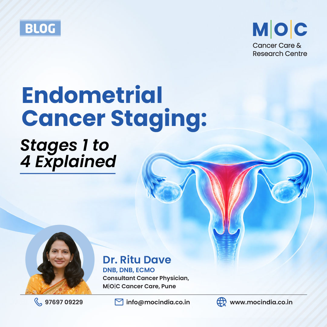 Endometrial Cancer Staging: Stages 1 to 4 Explained
